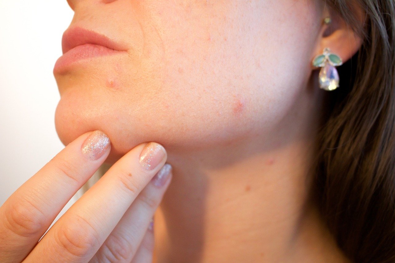 Svolta nella lotta all’acne, trovata la causa scatenante: è colpa di un’abitudine