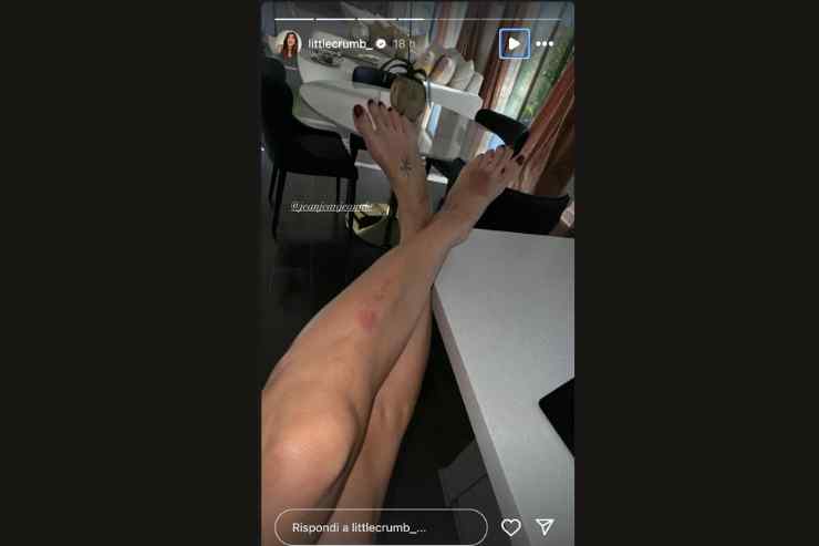 elisabetta canalis ferite e lividi sulle gambe