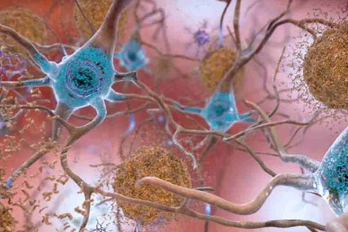 Novità Alzheimer
