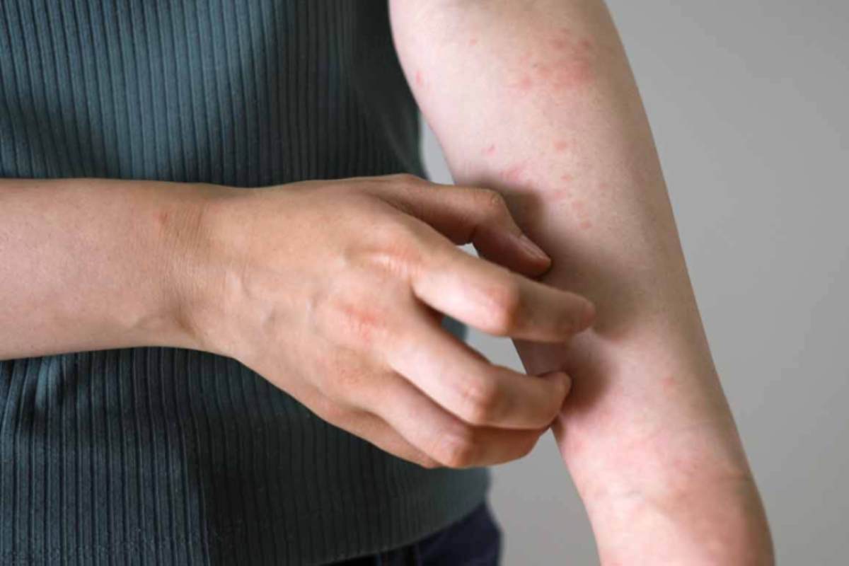 La scabbia fa paura, è boom di casi in Italia: ora è allarme La scabbia fa paura, è boom di casi in Italia: ora è allarme