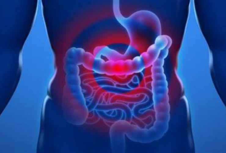 cancro allo stomaco