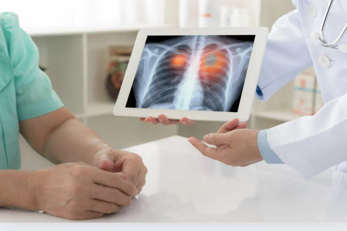 Cancro ai polmoni